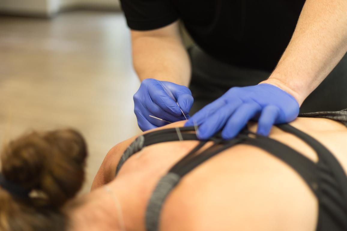 Dry Needling: What It Is and How It Helps 